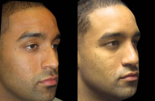 25-year-old-male-rhinoplasty-before-and-after-three-quarters-view-4.jpg