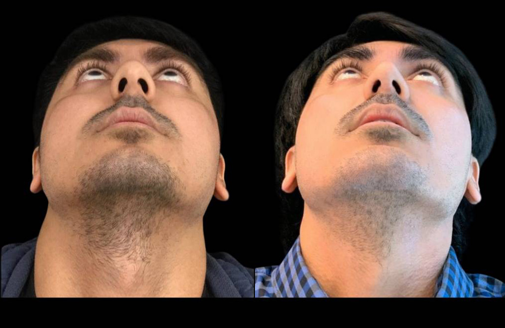25-year-old-male-rhinoplasty-before-and-after-worms-eye-view.jpg