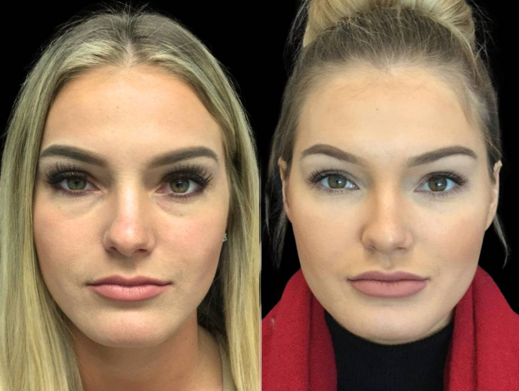26-year-old-female-juvederm-before-and-after-front-view-24694.jpg