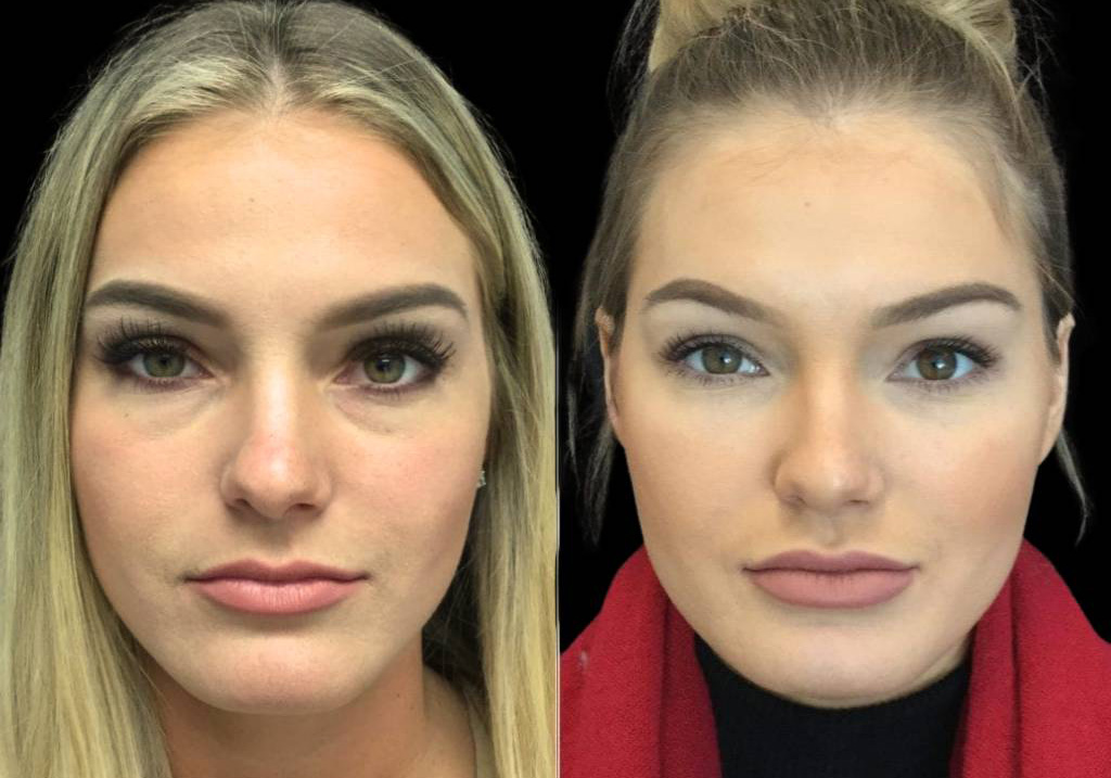 26-year-old-female-juvederm-before-and-after-front-view-24694.jpg