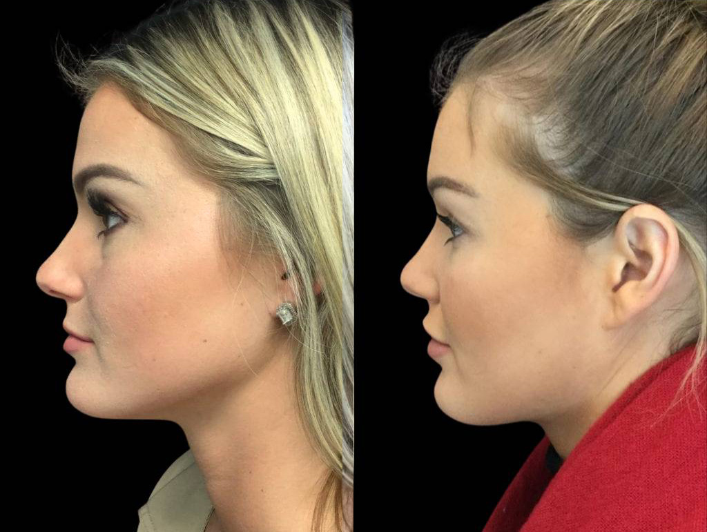 26-year-old-female-juvederm-before-and-after-side-view.jpg