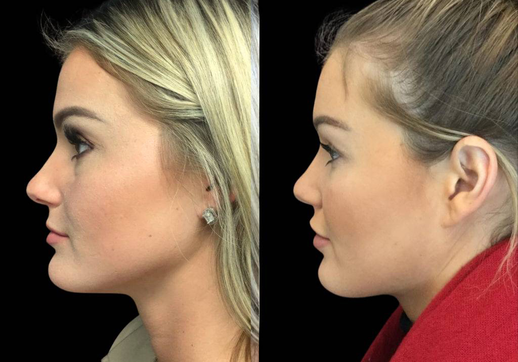 26-year-old-female-juvederm-before-and-after-side-view.jpg