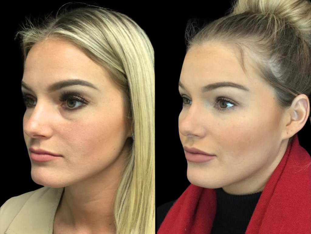 26-year-old-female-juvederm-before-and-after-three-quarter-view.jpg