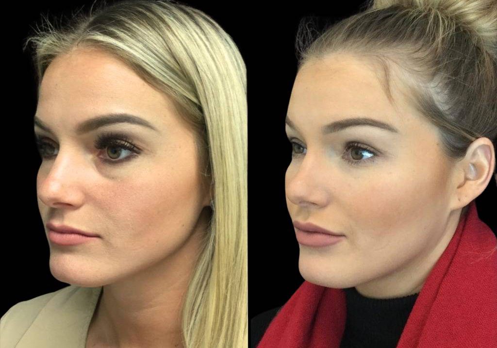26-year-old-female-juvederm-before-and-after-three-quarter-view.jpg