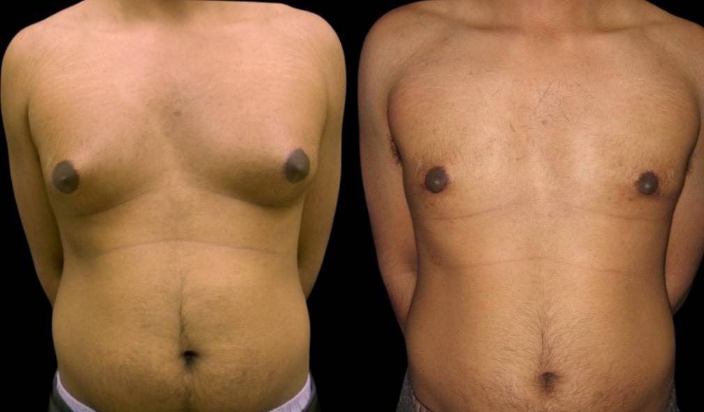 26-year-old-male-breast-reduction-before-and-after-front-view-11753.jpg