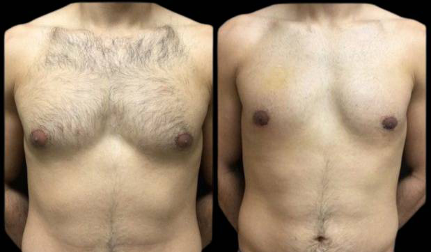 26-year-old-male-breast-reduction-before-and-after-front-view.jpg