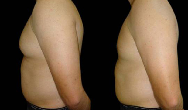 26-year-old-male-breast-reduction-before-and-after-side-view-1.jpg