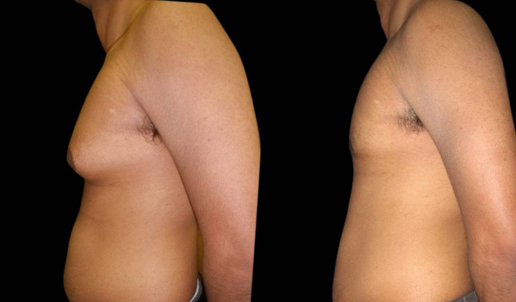 26-year-old-male-breast-reduction-before-and-after-side-view-2.jpg
