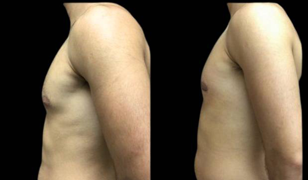 26-year-old-male-breast-reduction-before-and-after-side-view.jpg