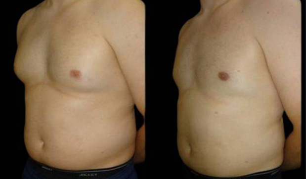 26-year-old-male-breast-reduction-before-and-after-three-quarter-view-1-1.jpg