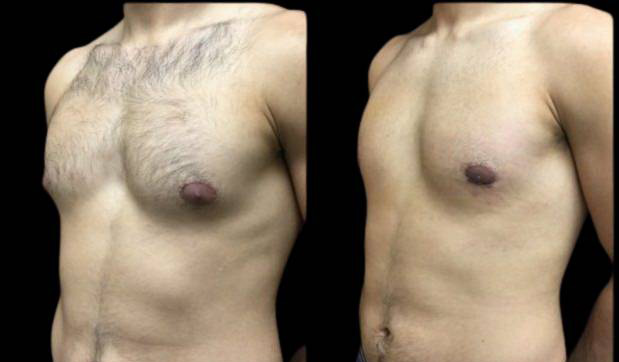 26-year-old-male-breast-reduction-before-and-after-three-quarter-view.jpg