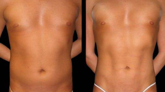 This is a 27-year-old female that has had an abdominal etching done showing the before and after's side-by-side