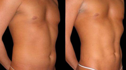 This is a 27-year-old female that has had an abdominal etching done showing the before and after's side-by-side