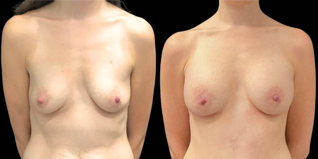 This is a 27-year-old female that has had a breast augmentation and implant showing the before and after's side-by-side