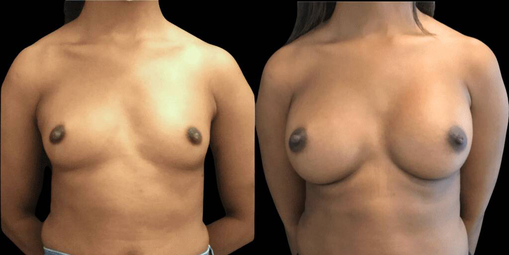 27-year-old-female-breast-augmentation-and-implant-before-and-after-front-view-255cc.jpg