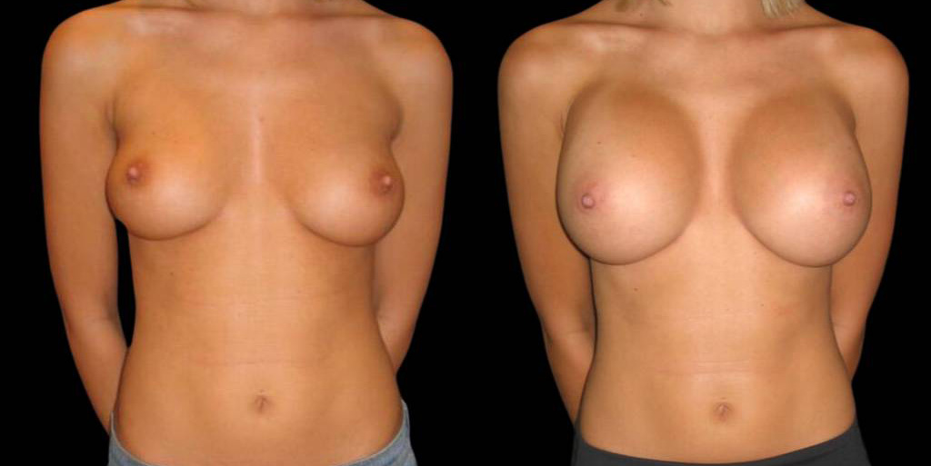 This is a 27-year-old female that has had a breast augmentation and implant showing the before and after's side-by-side