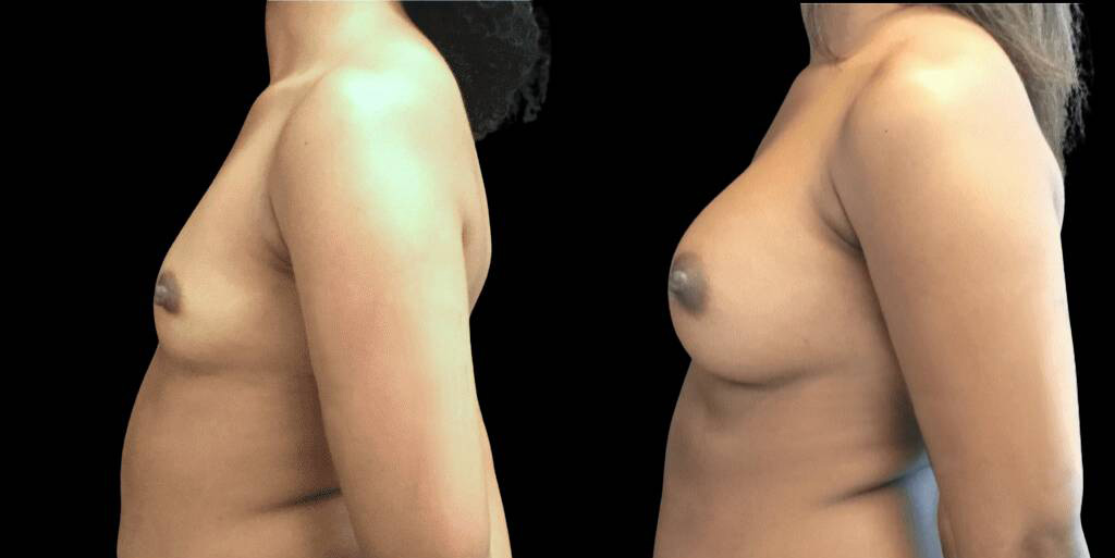 This is a 27-year-old female that has had a breast augmentation and implant showing the before and after's side-by-side