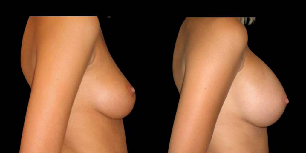 This is a 27-year-old female that has had a breast augmentation and implant showing the before and after's side-by-side