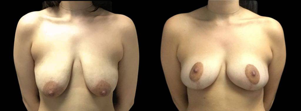 27-year-old-female-breast-lift-before-and-after-front-view.jpg
