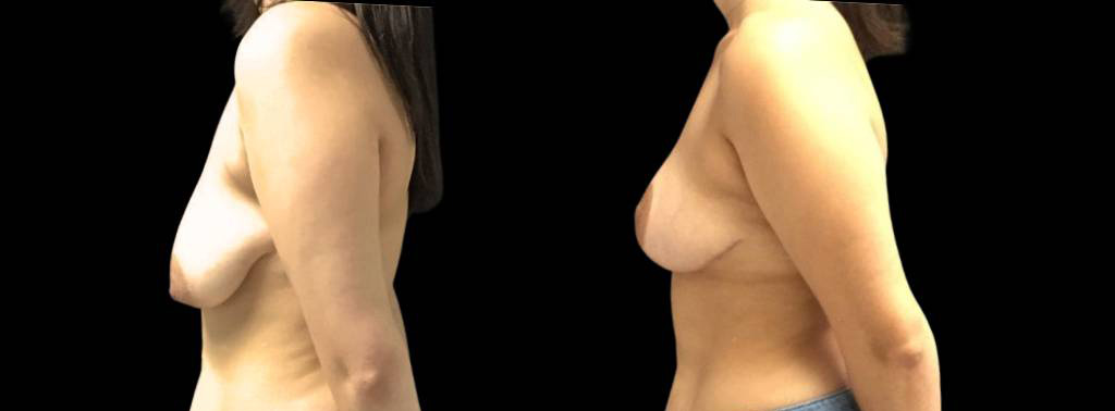 This is a 27-year-old female that has had a breast lift showing the before and after's side-by-side