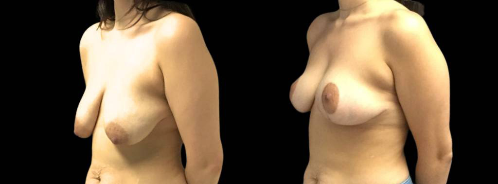 This is a 27-year-old female that has had a breast lift showing the before and after's side-by-side