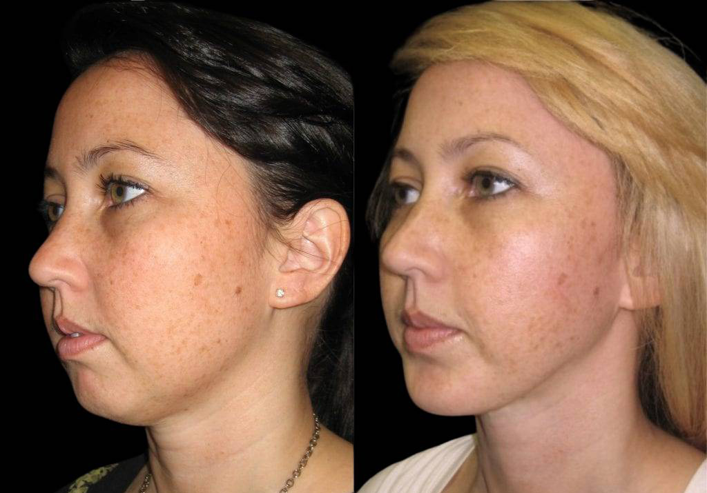 27-year-old-female-chin-implant-before-and-after-side-view.jpg