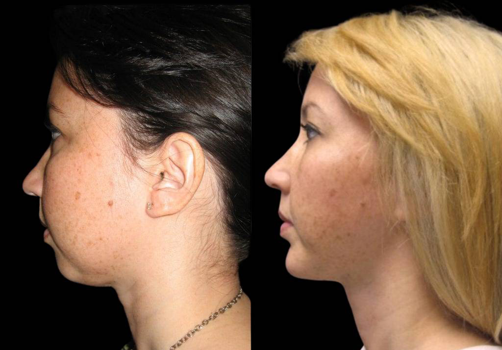 27-year-old-female-chin-implant-before-and-after-side-view-10120.jpg