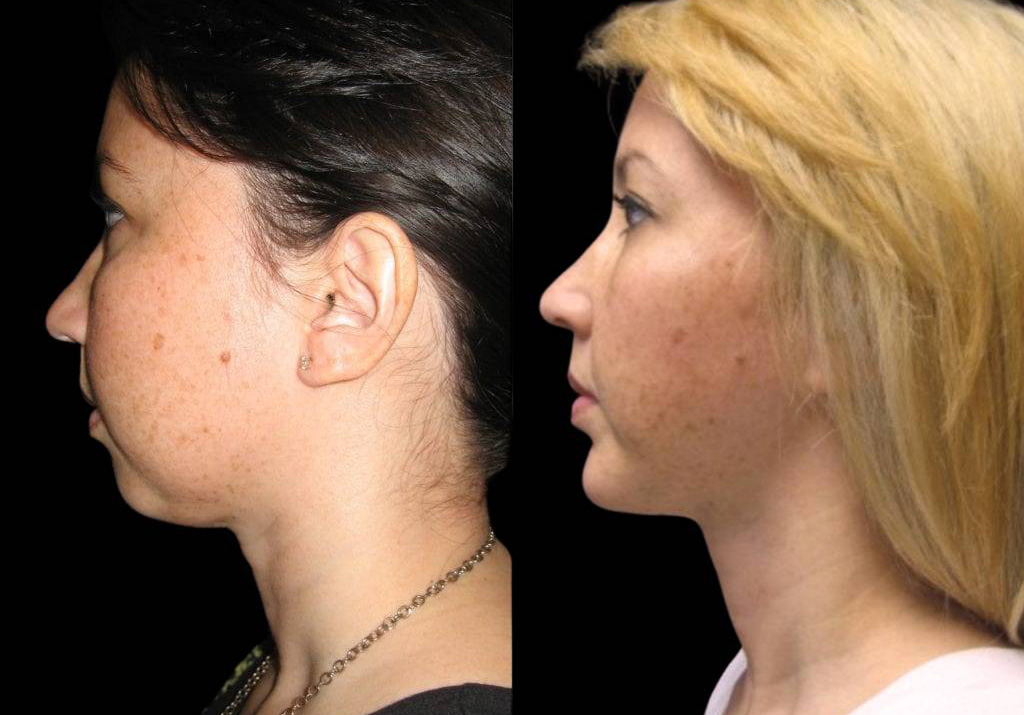 27-year-old-female-chin-implant-before-and-after-side-view-10120.jpg