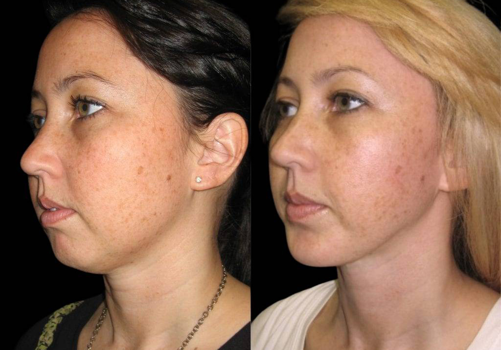 27-year-old-female-chin-implant-before-and-after-side-view.jpg