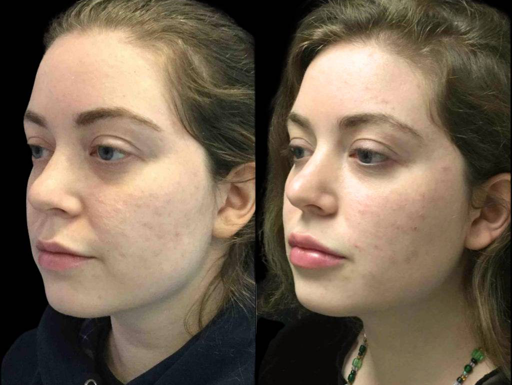 27-year-old-female-juvederm-before-and-after-three-quarter-view.jpg
