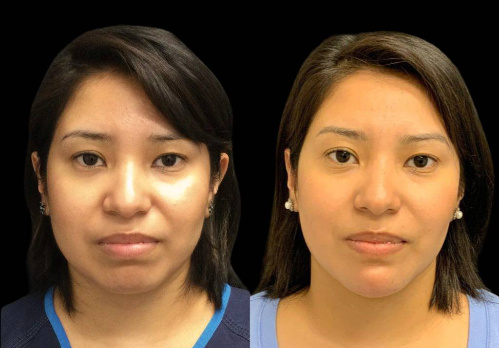 27-year-old-female-neck-liposuction-before-and-after-front-view-34435.jpg