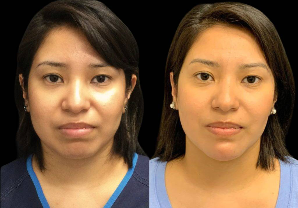 27-year-old-female-neck-liposuction-before-and-after-front-view-34435.jpg