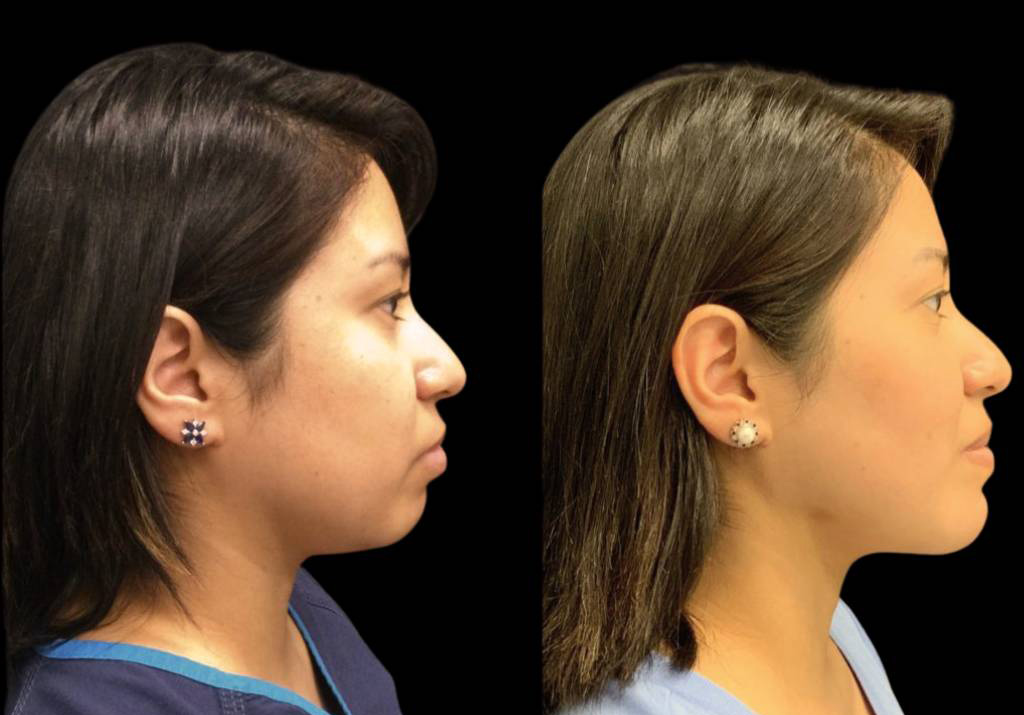 27-year-old-female-neck-liposuction-before-and-after-side-view.jpg