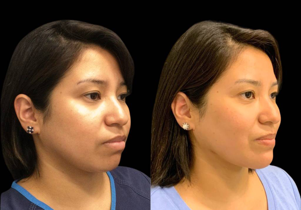 27-year-old-female-neck-liposuction-before-and-after-three-quarter-view.jpg