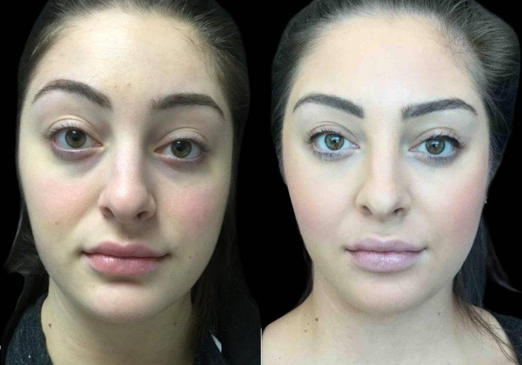 27-year-old-female-restylane-before-and-after-front-view-25686.jpg