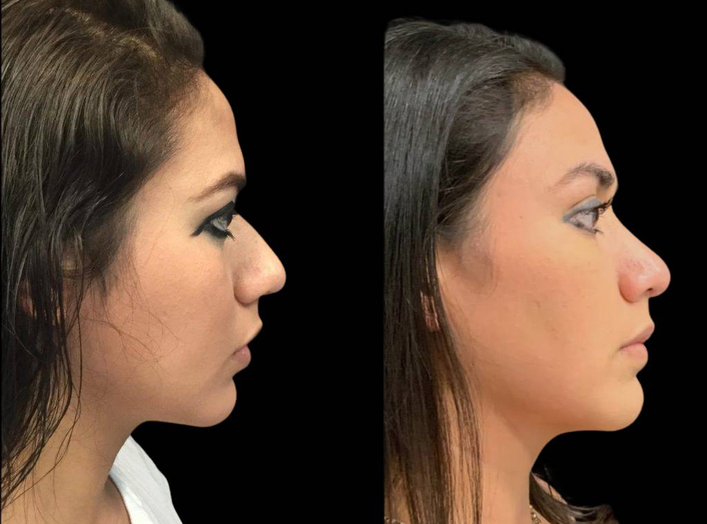 27-year-old-female-rhinoplasty-before-and-after-side-view.jpg