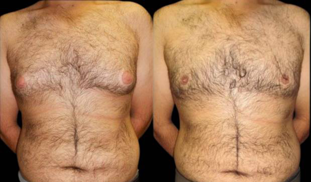 27-year-old-male-breast-reduction-before-and-after-front-view-6826.jpg