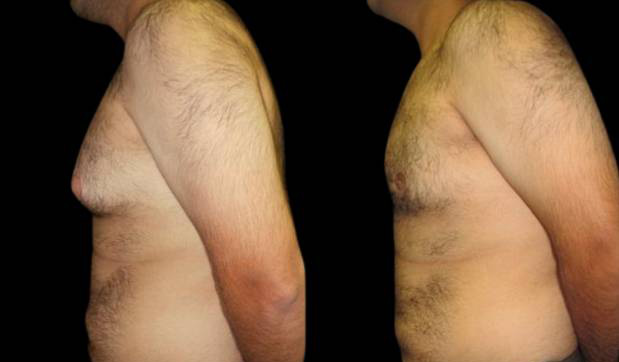 27-year-old-male-breast-reduction-before-and-after-side-view.jpg