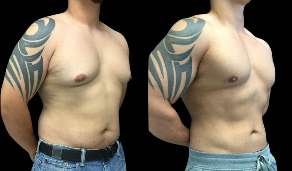 27-year-old-male-breast-reduction-before-and-after-three-quarter-view-1.jpg