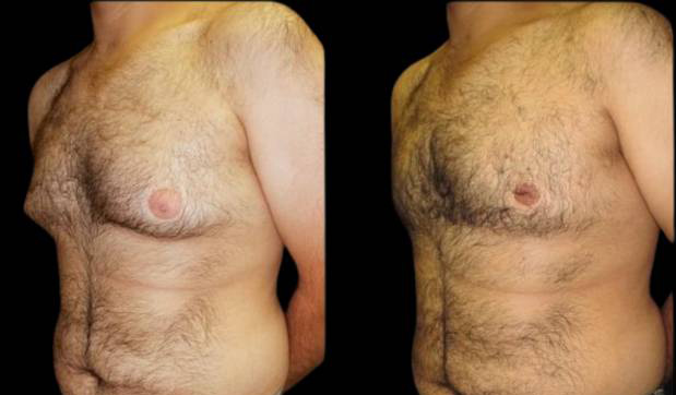 27-year-old-male-breast-reduction-before-and-after-three-quarter-view.jpg