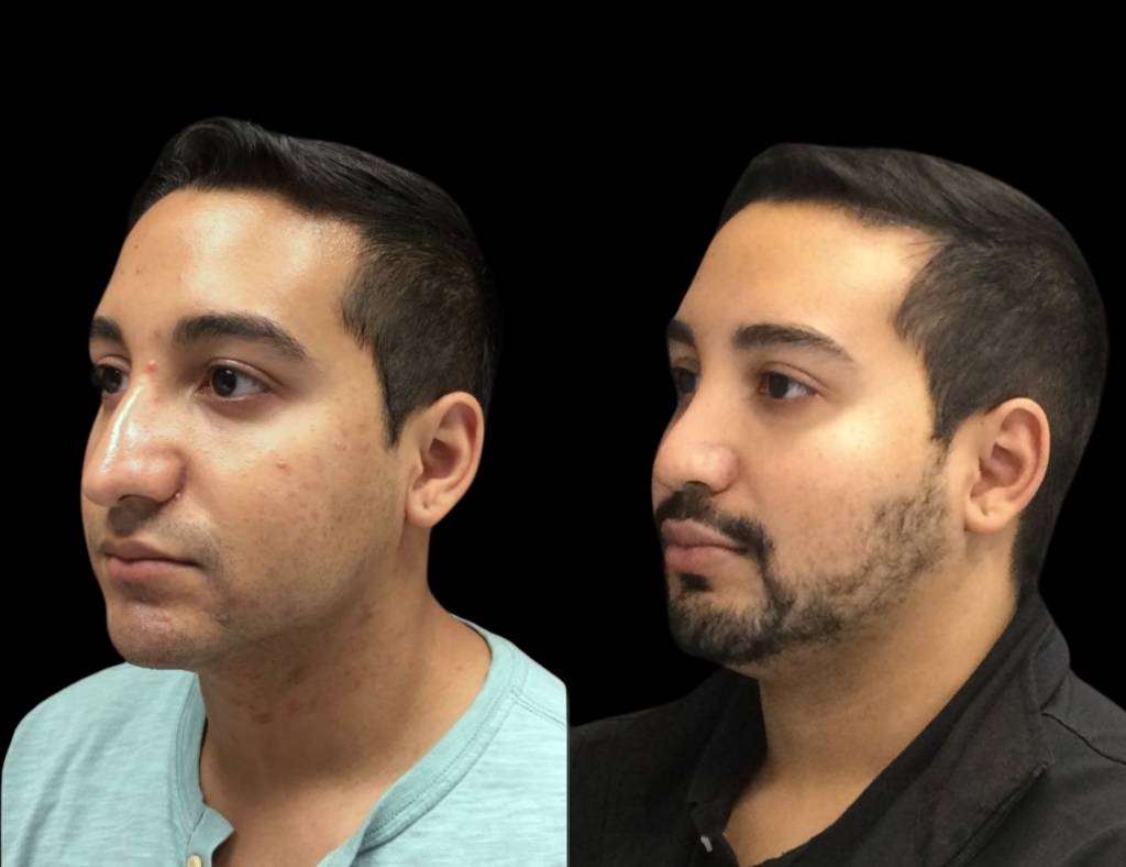 27-year-old-male-skincre-before-and-after-1