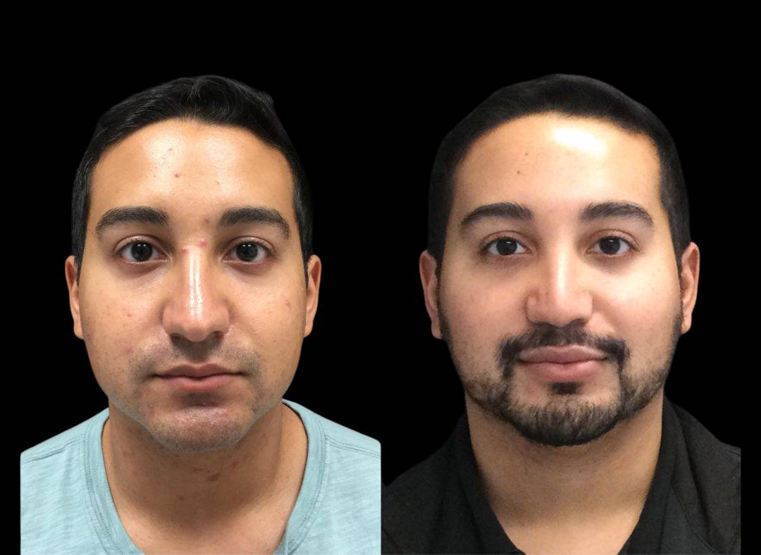 27-year-old-male-skincre-before-and-after.jpg
