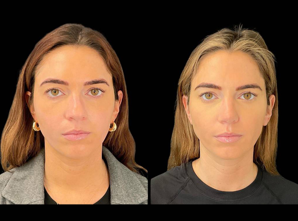 27-yr-old-female-Rhinoplasty-before-and-after-front-view.jpg