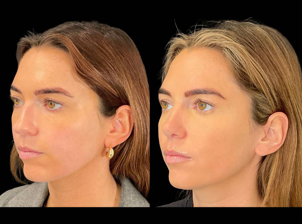 27-yr-old-female-Rhinoplasty-before-and-after-left-three-quarter-view.jpg