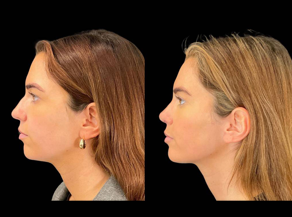 27-yr-old-female-Rhinoplasty-before-and-after-left-view.jpg