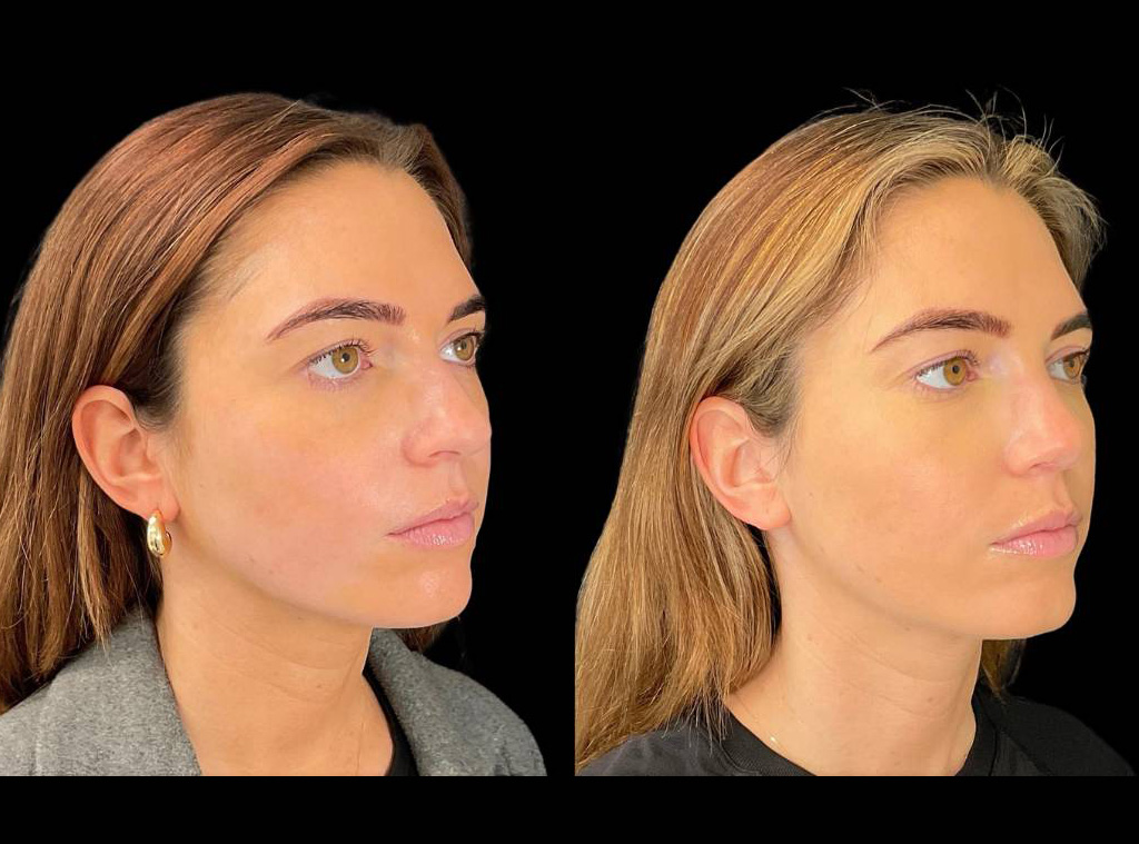 27-yr-old-female-Rhinoplasty-before-and-after-right-three-quarter-view.jpg
