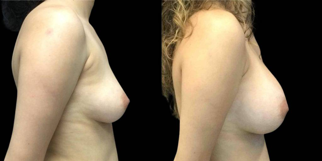 This is a 28-year-old female that has had a breast augmentation and implant showing the before and after's side-by-side