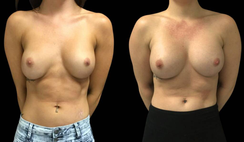 28-year-old-female-breast-implant-exchange-before-and-after-front-view-9818.jpg