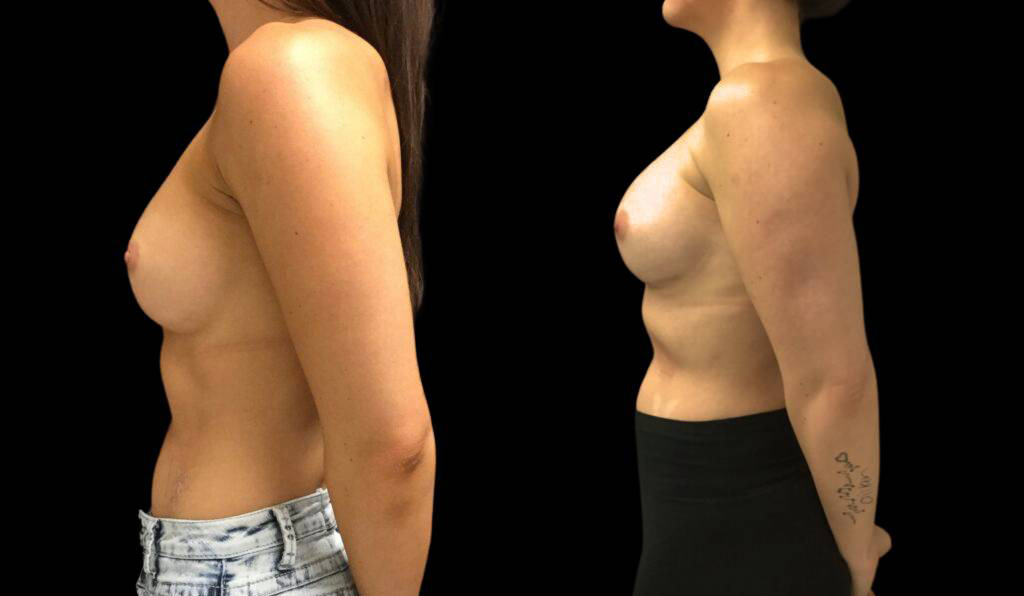 28-year-old-female-breast-implant-exchange-before-and-after-side-view.jpg