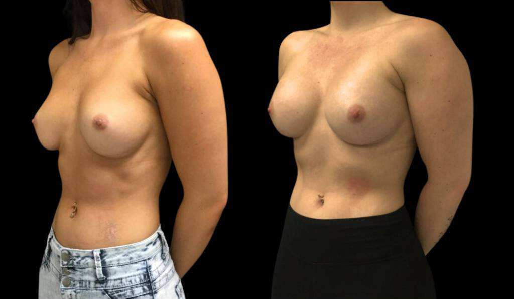28-year-old-female-breast-implant-exchange-before-and-after-three-quarter-view.jpg